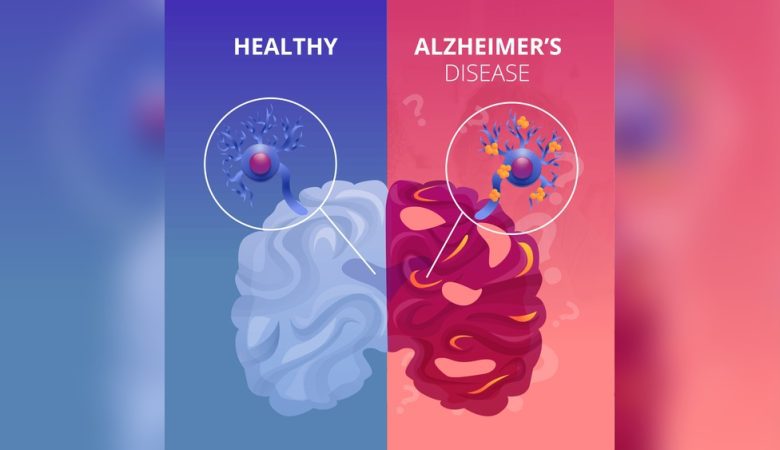 Alzheimer’s disease